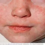 Measles Outbreaks Surge to Nearly 100 Cases in Texas and New Mexico