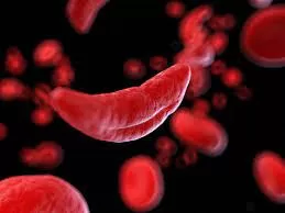 No Scientific Link Found Between Sickle Cell Trait and Sudden Death, Study Confirms