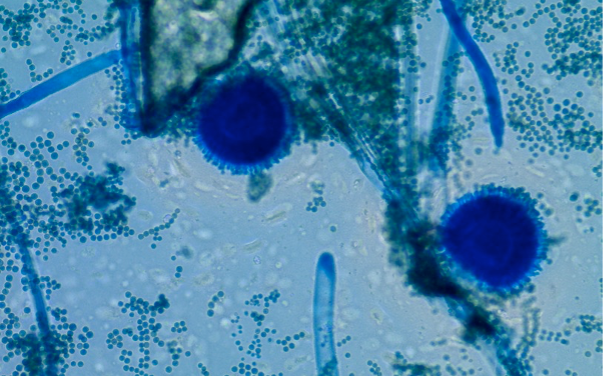 The Silent Pandemic: WHO Issues Urgent Blueprint to Confront Growing Global Fungal Threat