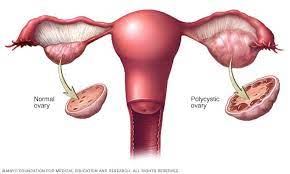 Uterine Artery Embolization Proves Effective in Preventing Hysterectomies Following Childbirth