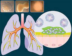 Rapid Spread of Hypervirulent Klebsiella Pneumoniae Raises Alarm Across European Healthcare Facilities