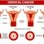 AI Model Flags Cervical Cancer Risk Years Early, But Experts Urge Clinical Validation