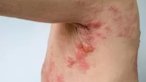 Survey Reveals Alarming Lack of Awareness About Shingles Among Indian Adults