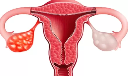 Experts Warn Women of Endometriosis: A Silent Threat to Fertility