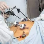 Bariatric Surgery Superior to GLP-1 RAs in Mortality Risk Reduction: Study