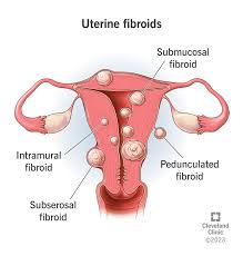 New Study Reveals Link Between Blood Pressure Control and Uterine Fibroid Prevention in Women