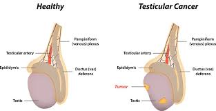 Experts Highlight Importance of Testicular Cancer Awareness among Young Men