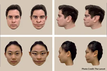 Breakthrough Research Unveils Visual Distortions in Rare Disorder