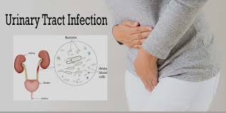 Oral Spray Vaccine Shows Promise in Preventing Recurrent Urinary Tract Infections: Study Reveals Long-Term Effectiveness