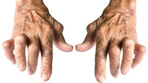 Breakthrough Study Unravels Mystery Behind Unresponsive Rheumatoid Arthritis Pain