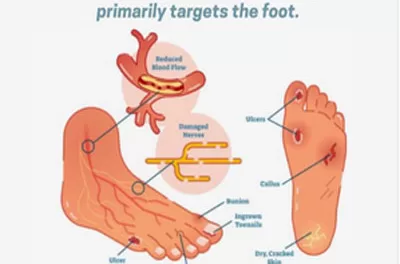 Expert Warns of Prediabetes Risks: Tingling Feet Could Signal Elevated Blood Sugar Levels