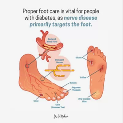 Expert Warns of Prediabetes Risks: Tingling Feet Could Signal Elevated Blood Sugar Levels