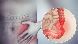 Fructose and Fructan Malabsorption Strongly Linked in IBS