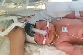 Extending CPAP Treatment Boosts Lung Growth in Premature Babies, Study Reveals