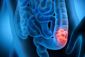 Behind the Spike in Colorectal Cancer Among Young Americans