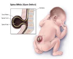 Breakthrough Study Reveals Genetic Link and Nutritional Factor in Spina Bifida