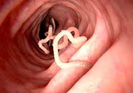 Parasitic Worms: Recognizing and Addressing Unusual Symptoms