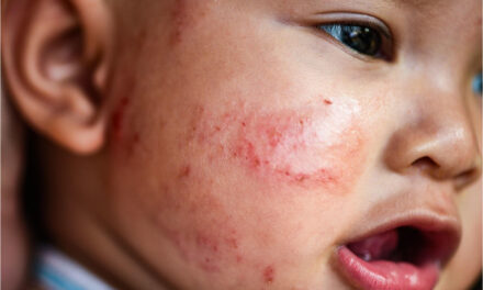 Tailored Vaccine May Revolutionize Eczema Treatment in Children, New Research Suggests