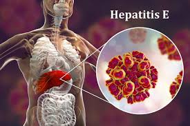 Hepatitis E Outbreak- Chad