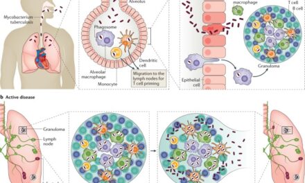 Study Urges Universal Preventive Treatment for Tuberculosis Regardless of Age