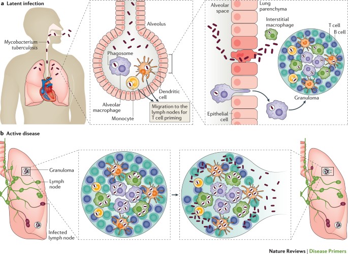 Study Urges Universal Preventive Treatment for Tuberculosis Regardless of Age