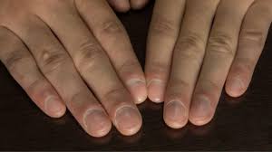 Nail Discoloration May Signal Risk of Cancerous Tumours, Study Finds