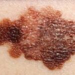 Diabetes Drug Metformin Linked to Reduced Skin Cancer Risk, Study Finds