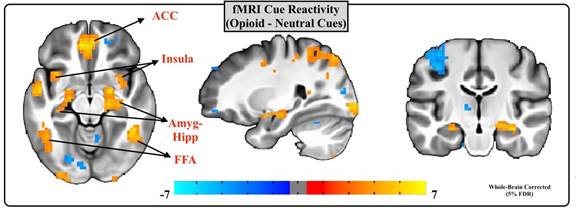 Yoga based intervention can reduce opioid dependence