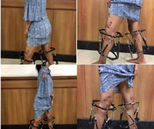 Teenage Girl’s Bowlegs Straightened with Innovative AI-Assisted Technique