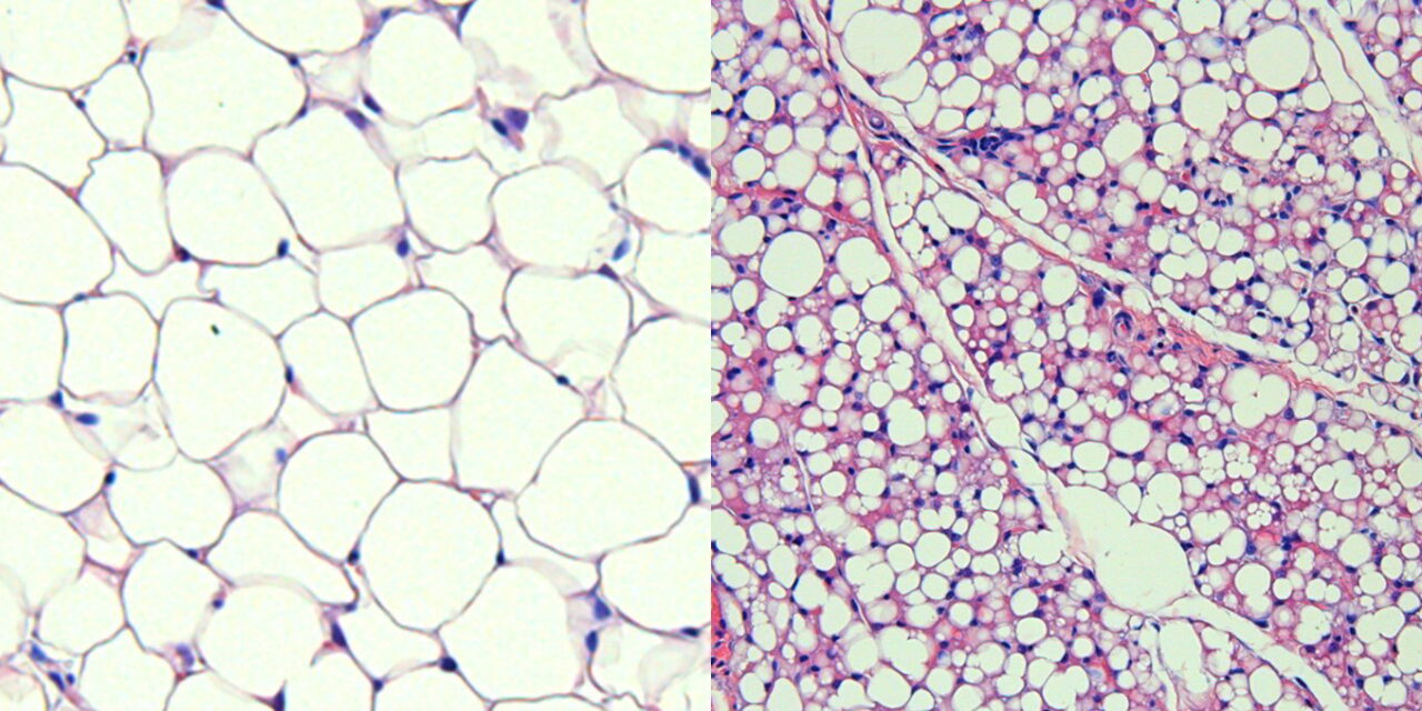 Brown Fat: A New Ally in Metabolic Health