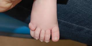 Discovery of a New Genetic Disorder Linked to Extra Fingers and Toes