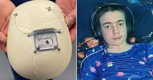 UK Teen Becomes First in the World to Receive Groundbreaking Brain Implant to Control Epilepsy