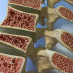 Levothyroxine May Contribute to Bone Density Reduction: Study