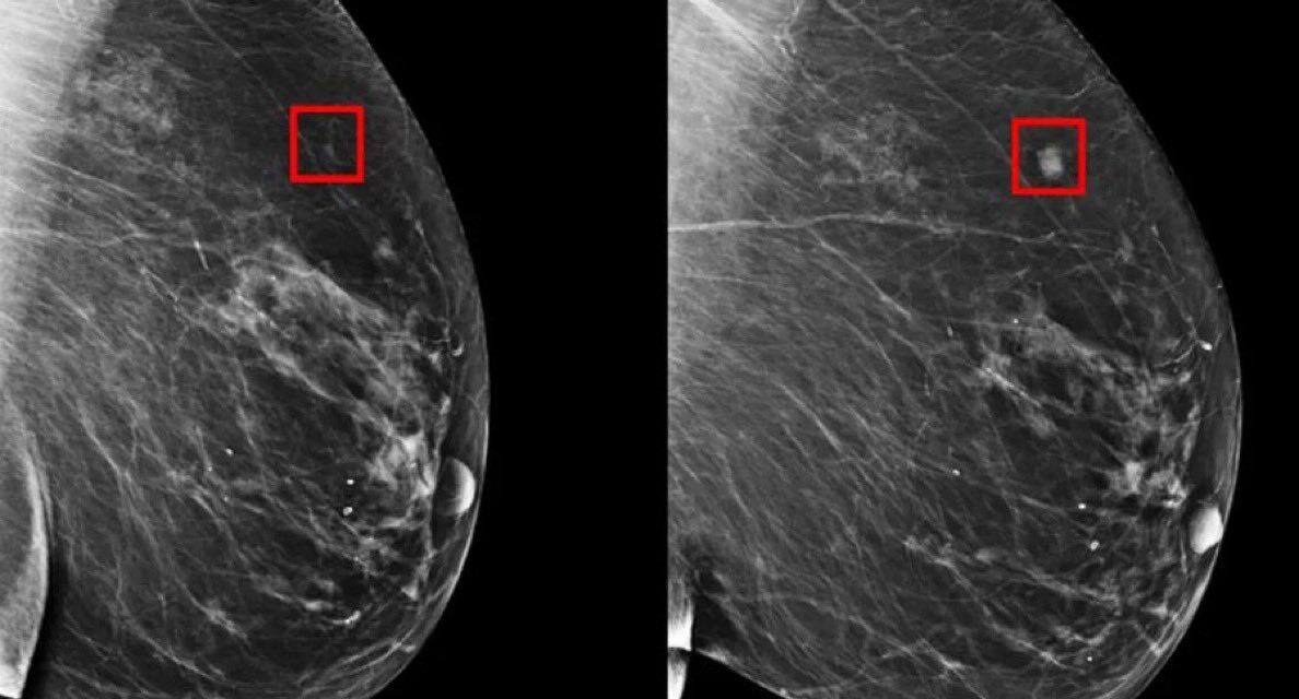 AI-Supported Breast Cancer Screening Shows Significant Accuracy Improvements, New Findings Reveal