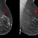 AI-Supported Breast Cancer Screening Shows Significant Accuracy Improvements, New Findings Reveal