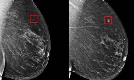 AI-Supported Breast Cancer Screening Shows Significant Accuracy Improvements, New Findings Reveal