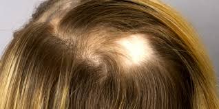 FDA Approves Leqselvi for Severe Alopecia Areata