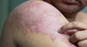 Men Twice as Likely to Develop Psoriasis: Experts Highlight the Need for Awareness