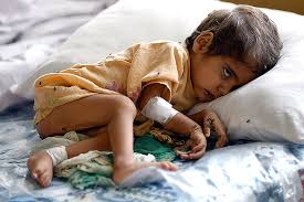 Severe Malnutrition in India: Alarming Statistics Reveal Health Crisis Among Children