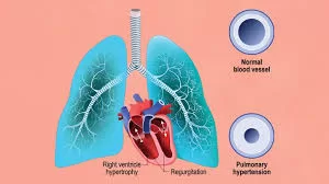 Indian Scientists Discover New Genetic Insights to Combat Deadly Lung Condition