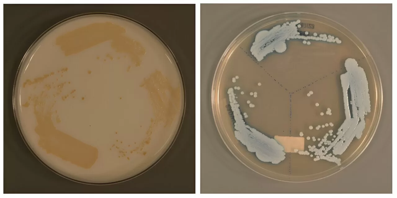 Unraveling the Spread of Candida auris: A Global Health Threat