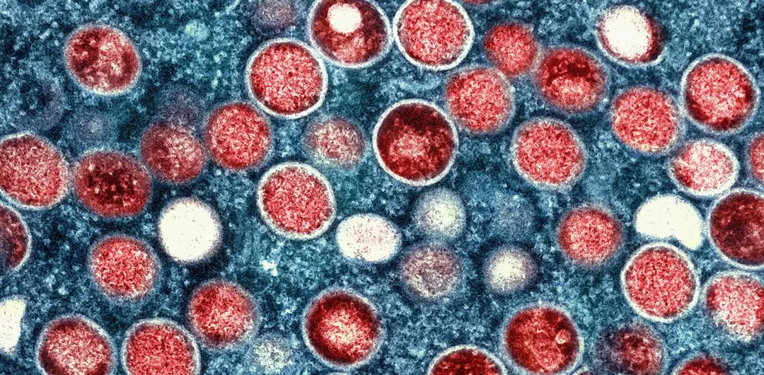 Sindh Health Department on High Alert as Mpox Cases Reach 25; Neonatal Cluster Sparks Concern