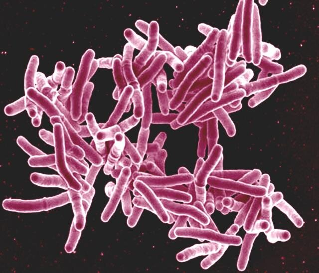 Unprecedented Tuberculosis Outbreak in Kansas: What It Means for Californians