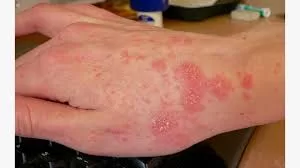 Scabies Outbreak in Hospitals: What You Need to Know