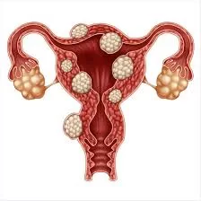 Medical Therapy for Fibroids Should Be Prioritized Over Hysterectomy, NEJM Report States