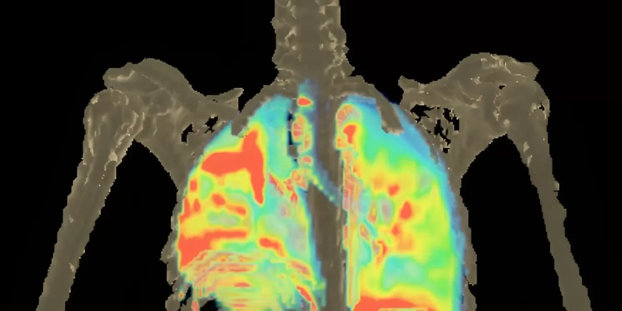 Johns Hopkins Researchers Unveil Potential Breakthroughs in Treating Multidrug-Resistant TB Meningitis