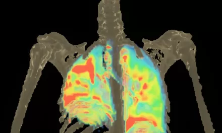 Johns Hopkins Researchers Unveil Potential Breakthroughs in Treating Multidrug-Resistant TB Meningitis