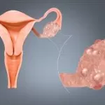 The Hidden Triple Threat: Why PCOS, Thyroid Issues, and Heart Disease are Surging in Women