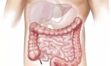 Understanding Colorectal Cancer: A Growing Health Concern