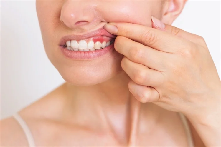 Gum Disease Tied to Higher Thrombosis Risk: Could Periodontal Therapy Help Save Lives?